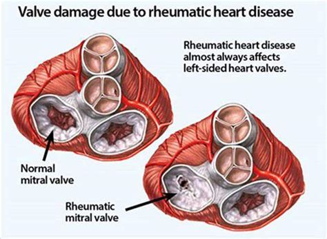 Types Symptoms And Causes Of Heart Valve Disease Onlymyhealth