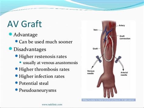 Dialysis access interventions