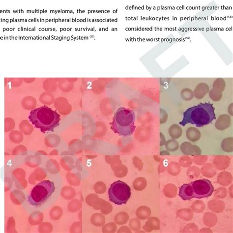 Plasma Cells In Peripheral Blood Download Scientific Diagram