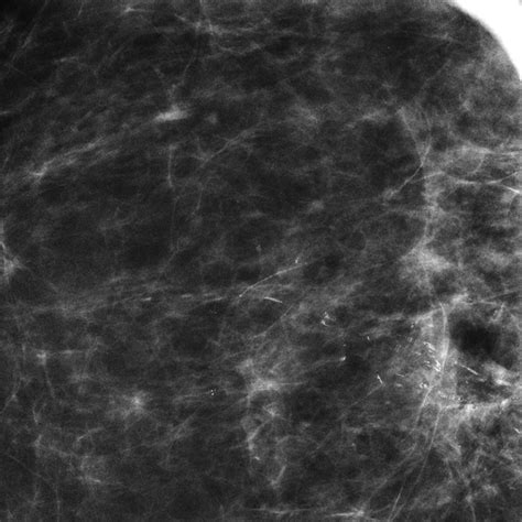 Linear Breast Calcifications AJR