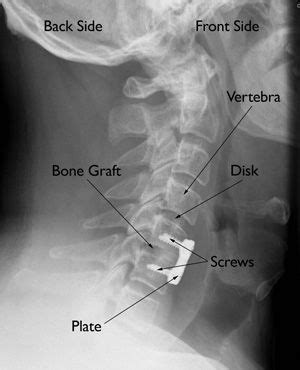 Types Of Anterior Cervical Fusion