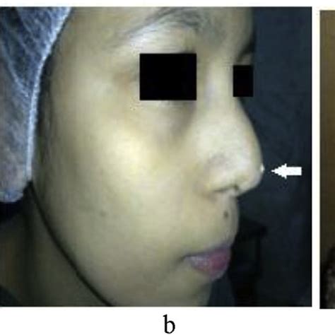 (a) Coronal CT scans showing a bifid crista galli in a 16-year-old ...