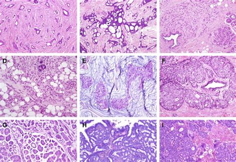 Breast Cancer Detection Using Deep Learning Sopra Steria