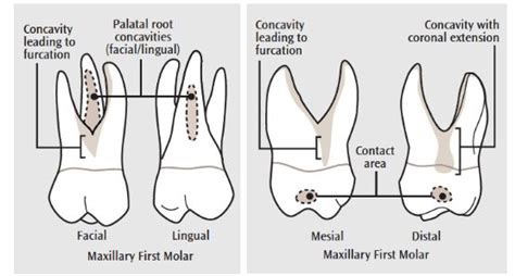 First Molar Teeth Provide Challenges In Instrumentation Memorizing The