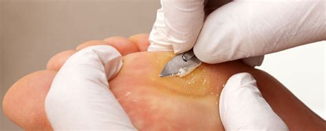 Remove calluses - Medisch Pedicure Esther Amsterdam