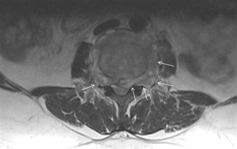 Spinal Epidural Abscess In Brucellosis Bmj Case Reports