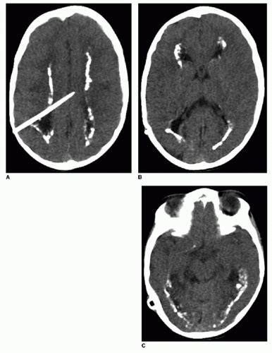 Intracranial Infection And Inflammation Radiology Key