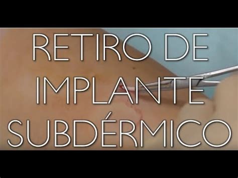 Inserción y retiro de implante subdérmico Dr Edgard Rodríguez