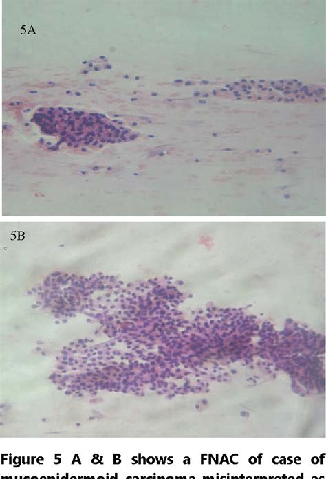 Figure 1 From Pitfalls In Salivary Gland Fine Needle Aspiration