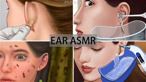 Asmr Remove Ear Piercing Pus Ear Pimple Blackhead Care Sebaceous Cyst Removal Ear Cleaning