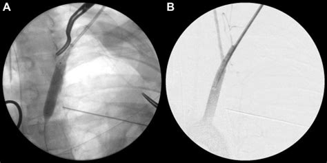 Hybrid Repair Of Complex Left Subclavian Artery Injury With Partial