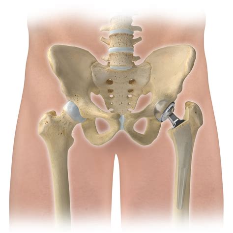 Hip Replacements May Require A Revision Why Beacon Orthopaedics