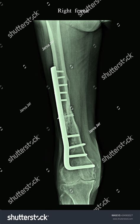 Xrays Showing Fracture Right Femur Stock Photo 434983027 | Shutterstock