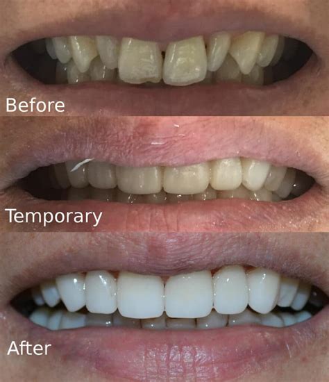 Dental Veneers Near Me Dental Veneers Cost Edge Dental Houston