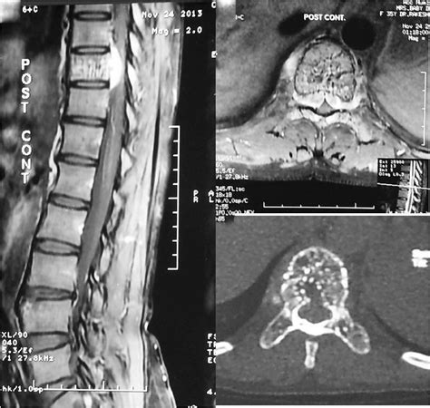 Long Term Outcome Of Treatment Of Vertebral Body Hemangiomas With