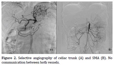 Celiac Artery Angiogram