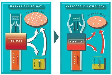 Causes And Treament Of Varicocele Georgiadis Urology