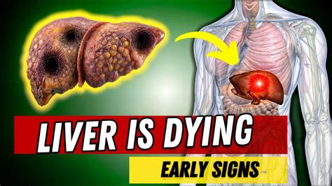 12 Warning Signs Of Cirrhosis End Stage Liver Damage Youtube