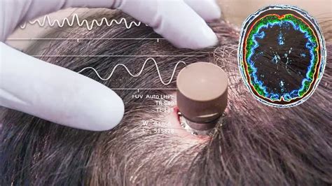 Neuralink De Elon Musk Logra Implantar Con Xito El Chip Cerebral