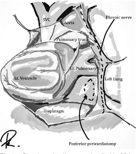 Figure From The Posterior Pericardiotomy Does It Reduce The