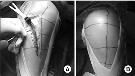 Figure 1 From Conversion Of Total Knee Arthroplasty After High Tibial