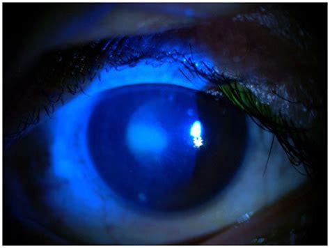 Corneal Epithelial Defect And Abrasion Observed After Fluorescein