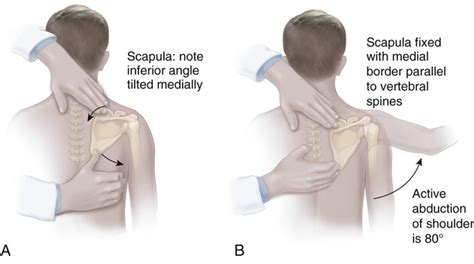 Scapulocostal Stabilization For Scapular Winging Ketenjian