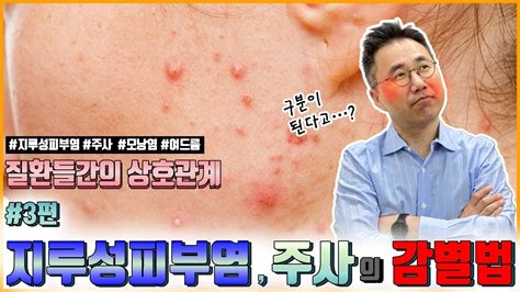 💥지루성피부염과 주사의 감별법을 알아 봅니다 👉지루성피부염주사여드름모낭염의 관계를 알아보는 시리즈 3️⃣ Youtube