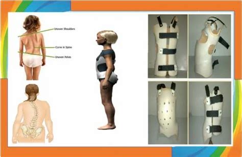 Scoliosis & Kyphosis brace - Custom Milwaukee Brace Manufacturer from Hyderabad