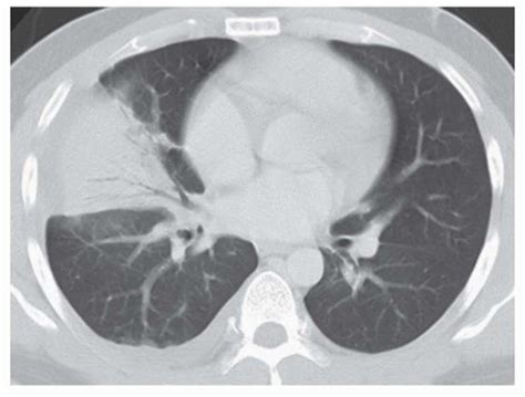 Consolidation And Atelectasis Radiology Key