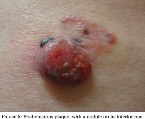 Figure 1 From Dermoscopic Clues In The Diagnosis Of Amelanotic And