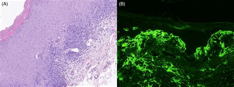 A Histology Band‐like Lymphocytic Infiltrate B Direct Download