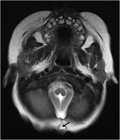 Occult craniocervical dysraphism and skin markers | BMJ Case Reports