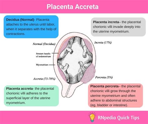 Placenta accreta nursing management – Artofit