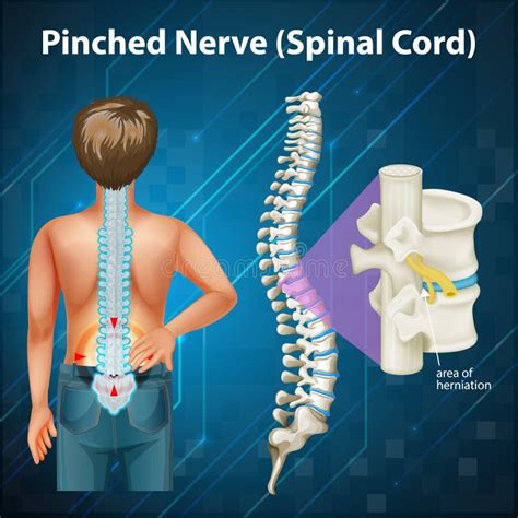 Spinal Cord Cartoon Stock Illustrations 280 Spinal Cord Cartoon Stock