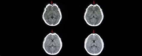 Traumatic Brain Injury or TBI | Misdiagnosis Association and Research ...