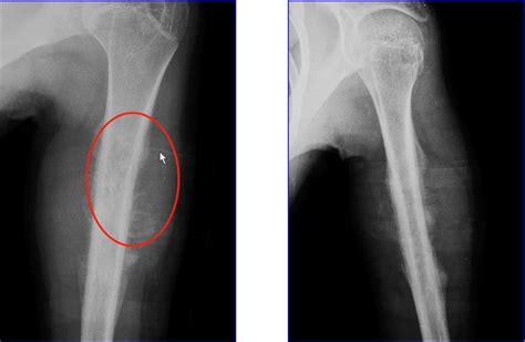 超详细的骨肿瘤与肿瘤样病变影像诊断不要错过 骨瘤 软骨 病例