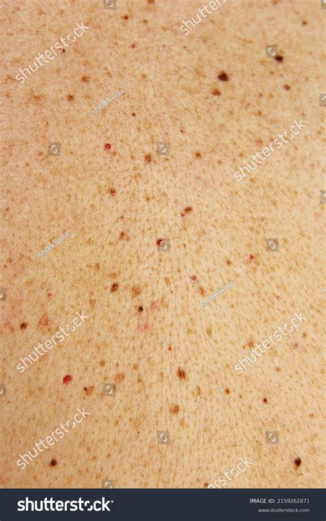 Moles Birthmark On Human Skin Texture Stock Photo 2159262871 Shutterstock