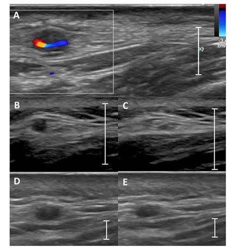 Typical Aspect Of Vasculitis In Temporal Arteries A Example Of The