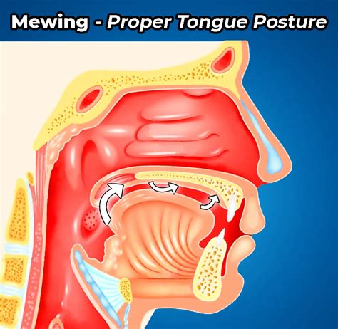 13 Mewing Mistakes That Can Hurt and Cause Pain & Discomfort