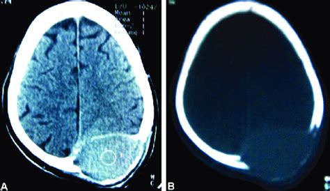 Ct Scan Head A With Bone Window B Showing An Expansile Lytic Lesion