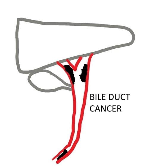 Bile Duct Cancer Treatment in Hyderabad - Dr. K V Dinesh Reddy