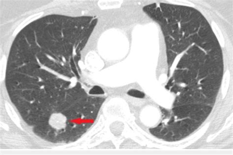 Benign Lung Tumor