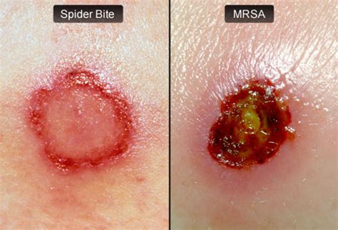 Healthy Life: MRSA (Methicillin-Resistant Staphylococcus Aureus)