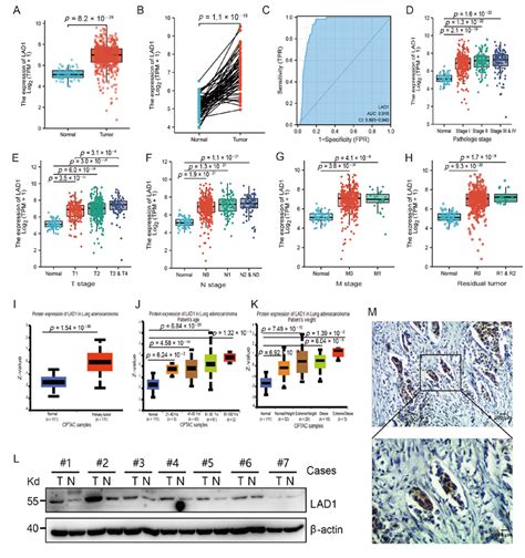 The Upregulation Of Lad Expression In Luad Patients A Comparison Of