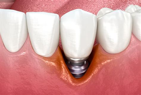 Peri Implant Diseases Essential Endodontics