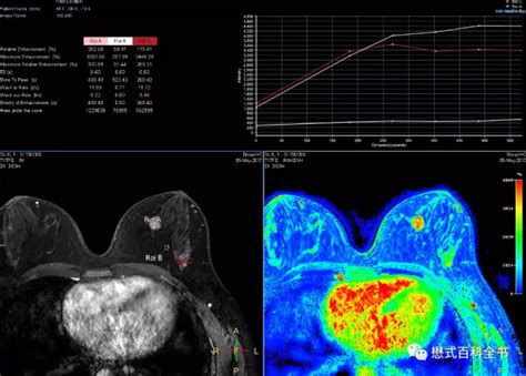 磁共振乳腺扫描规范及全流程技术分享 知乎