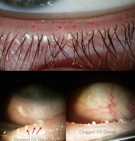 What Is Meibomian Gland Dysfunction