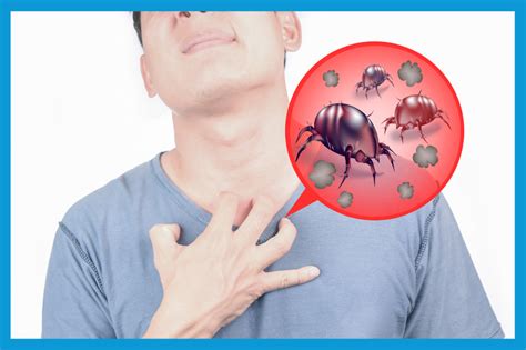 Synthétiser 25+ articles sur le sujet : allergie aux acariens que faire ...