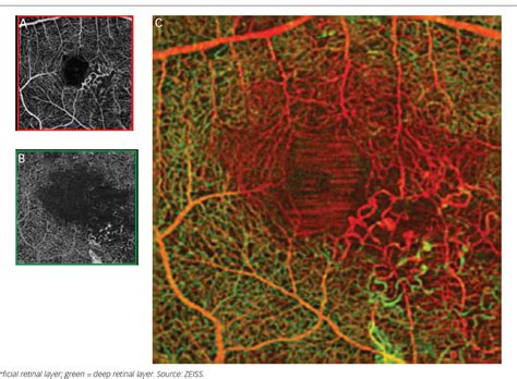 Figure From Angiographic Imaging Of Retinal Vasculature In Specific